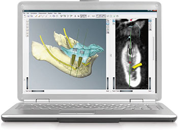 Représentation implant guidée